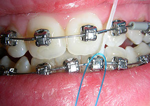 Clear Braces - Cori S. Hvideberg, DMD